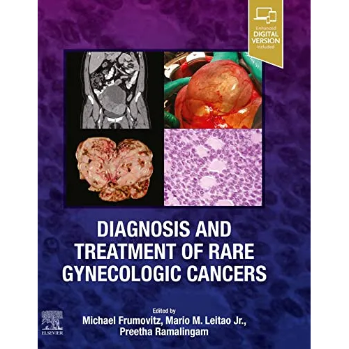 Diagnosis and Treatment of Rare Gynecologic Cancers