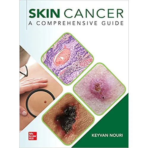 Skin Cancer: A Comprehensive Guide